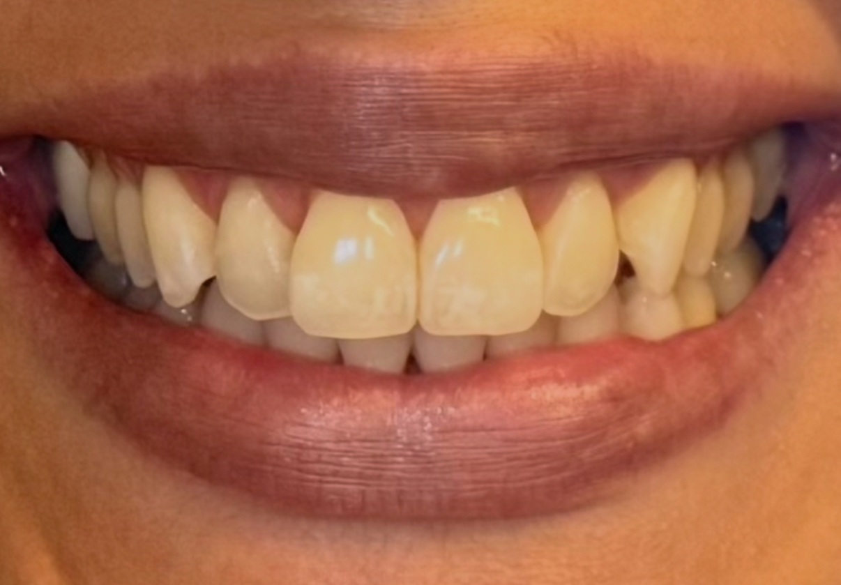 Smile Makeover - Before